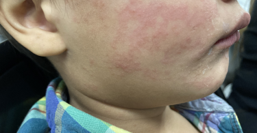 close up of young child's face with measles rash